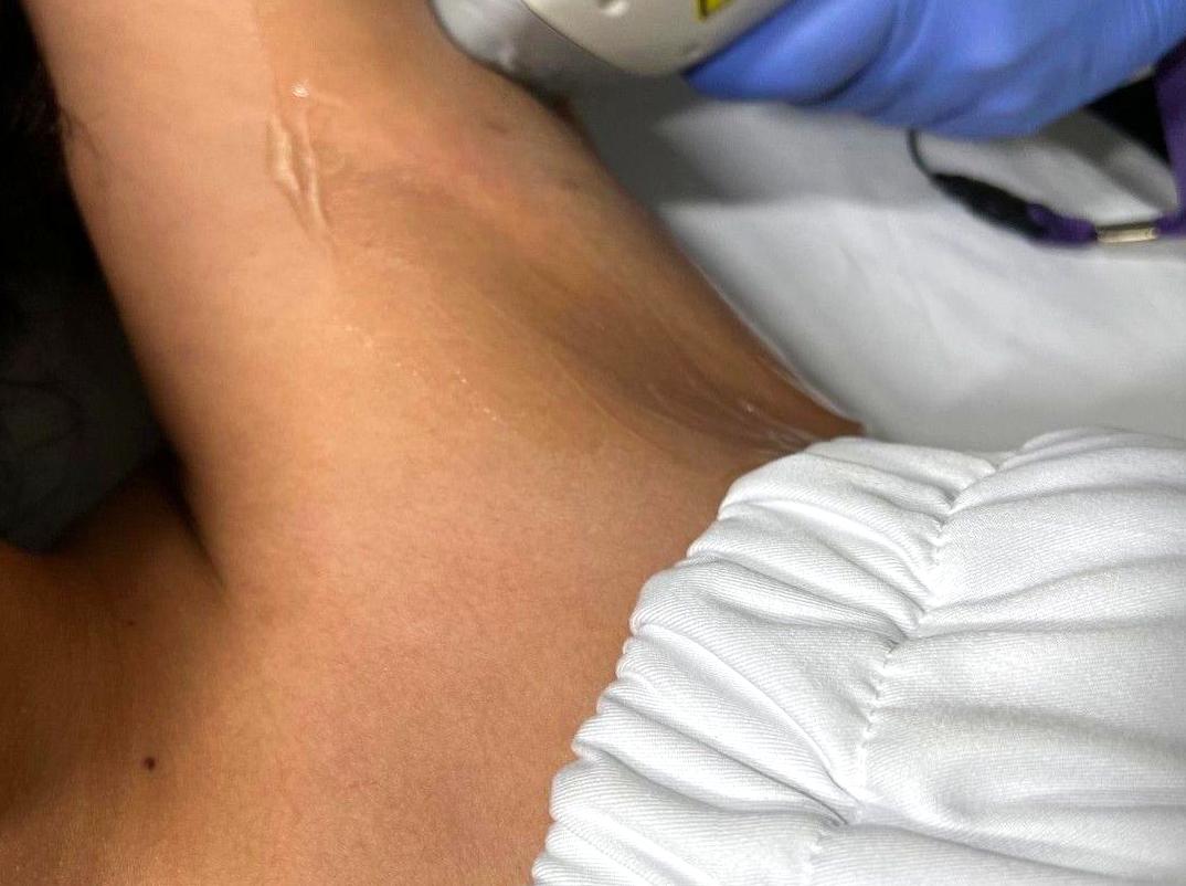 Can I apply fake tan following laser hair removal?