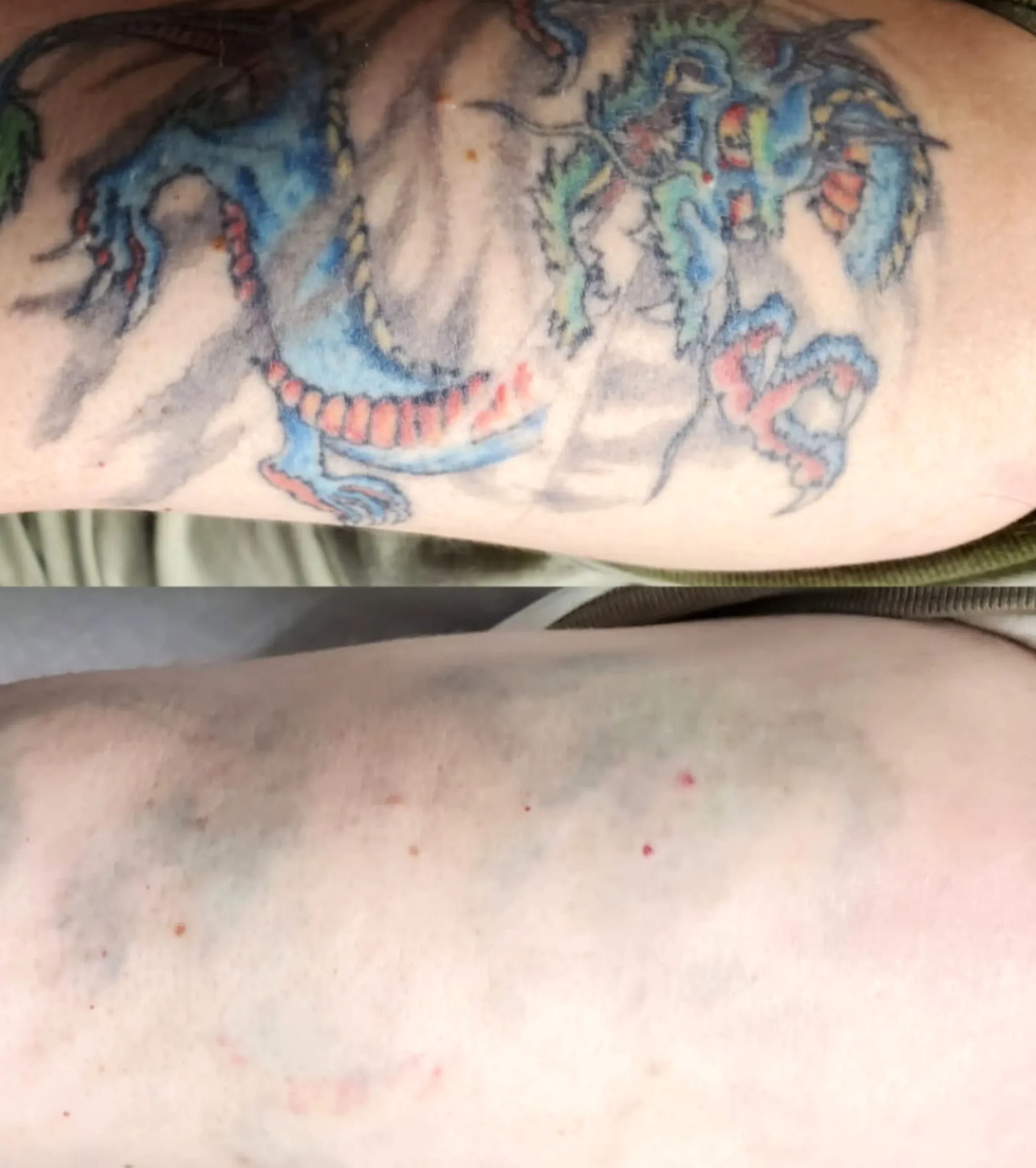 cost of tattoo removal