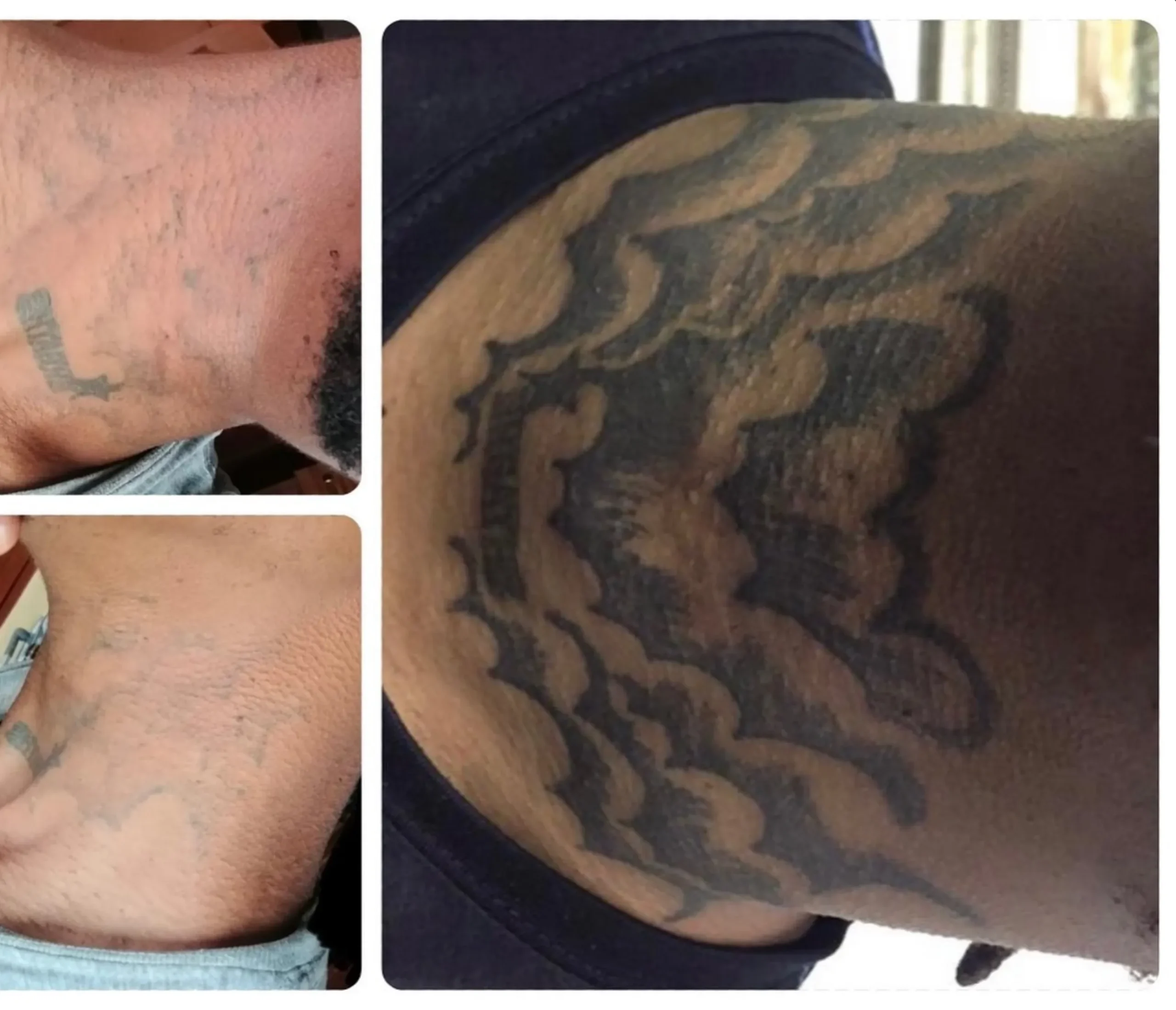 tattoo laser removal cost